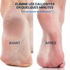 Cleanfeet® Râpe à pieds élimine les callosités des pieds